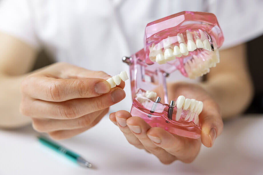 Bridge vs Implant for Missing Teeth: Cost and Longevity Compared