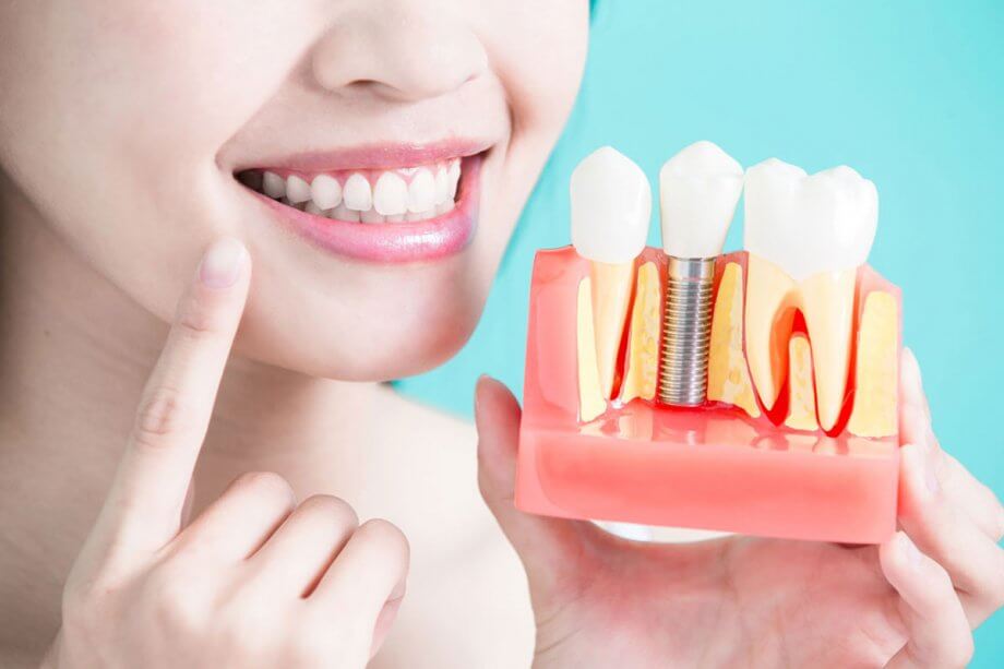 4 Myths About Dental Implants