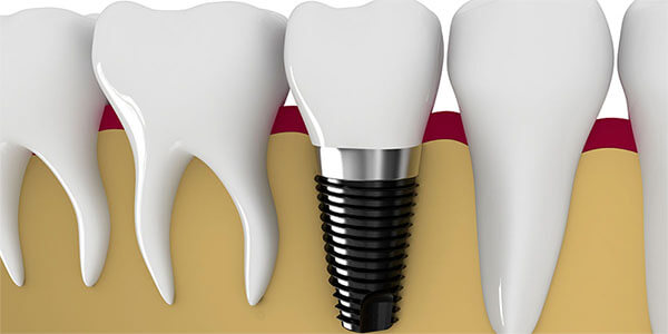 Dental Implants in Framingham, MA