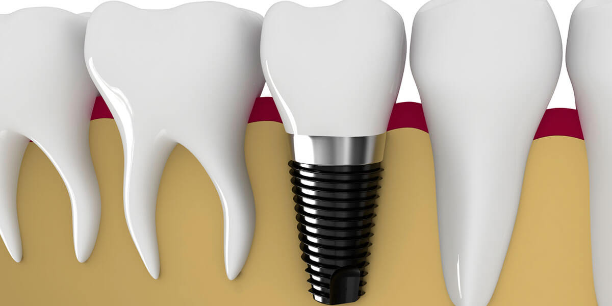 Dental Implants in Framingham, MA