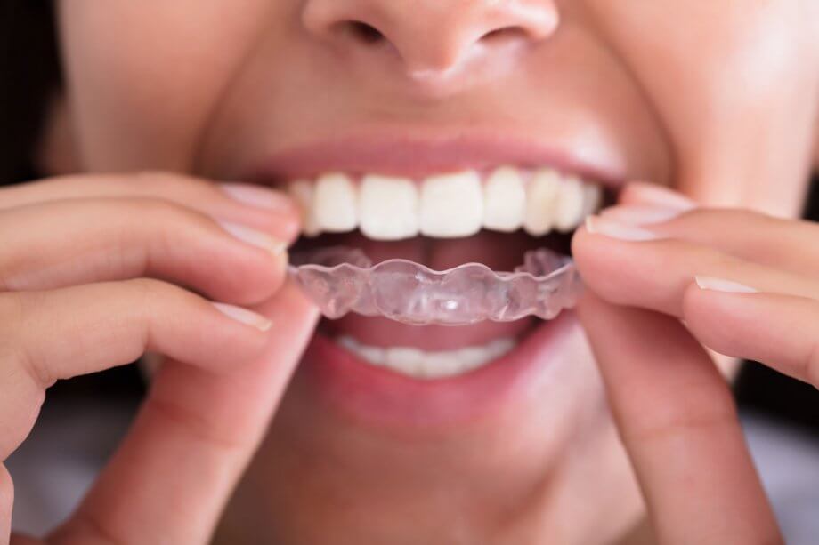 5 Benefits of Invisalign